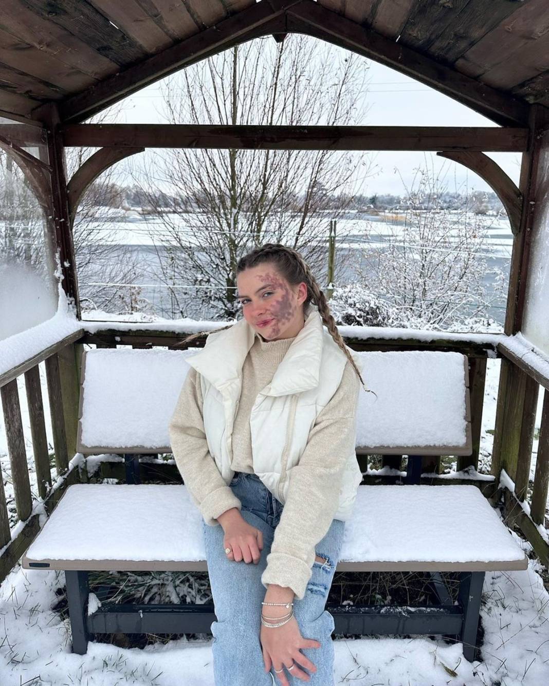 Basit bir uçuk zannetti, korkunç hastalığa yakalandı! Doktorlar bile teşhis koyamadı 2